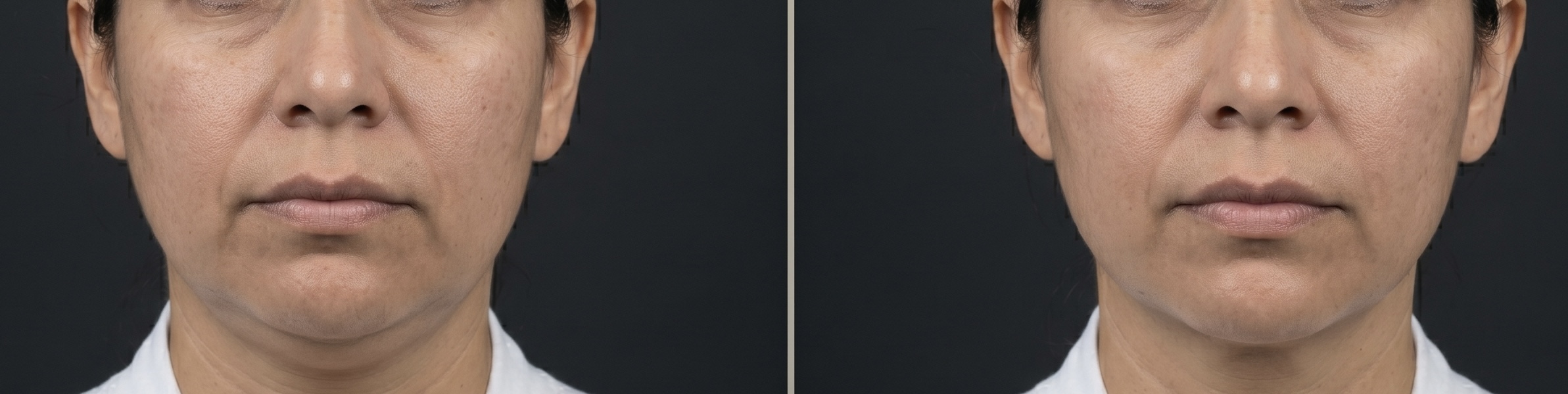 Antes y después Endolifting rostro mujer — Dr. Kevin Ramírez Popayán