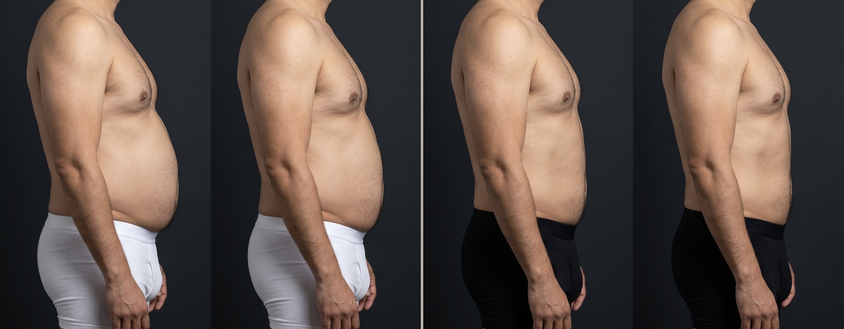 Antes y después Endolifting abdomen perfil — Dr. Kevin Ramírez